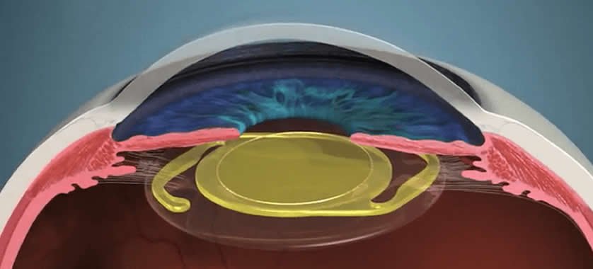 lente-intraocular-cirurgia-de-catarata-sp